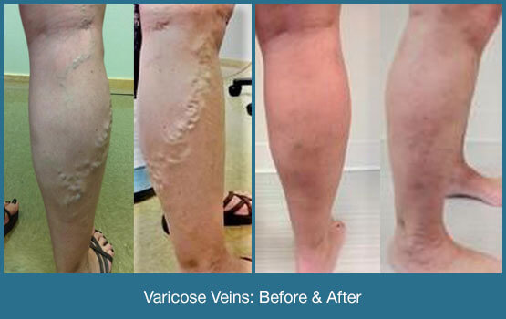 Varicose Veins Before & After Photo